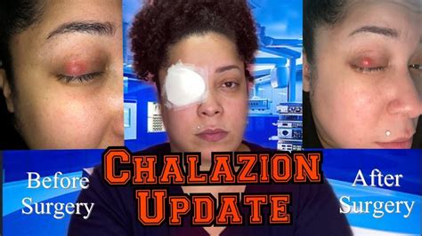 Chalazion Update | I had Surgery - YouTube