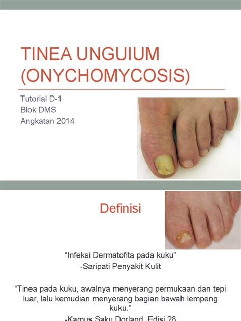 TINEA Unguium (Onychomycosis) | Perawatan Medis | Farmakologi