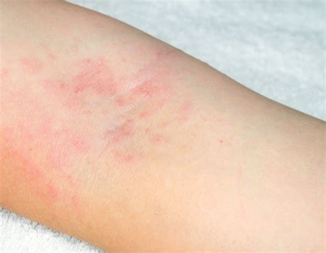 Types Of Rashes On Skin | Images and Photos finder