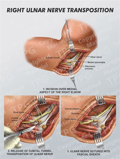 Ulnar Nerve Release