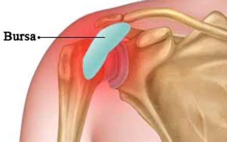 Shoulder Bursitis - Causes, Symptoms and Exercises