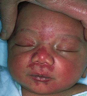 Study Medical Photos: Nevus Simplex Or A Salmon Patch - A Vascular ...