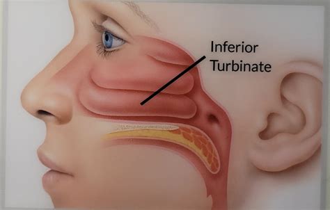 Nasal Turbinate Hypertrophy in New York, NY | Dr Kamran Jafri MD FACS