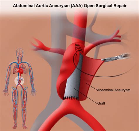 how long does an aortic aneurysm repair last - Kathrin Qualls