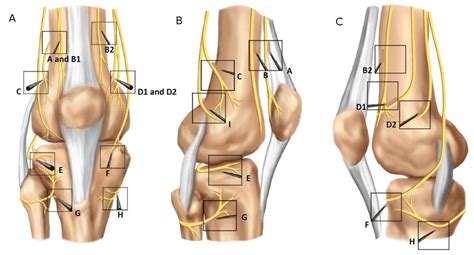 Technical Considerations for Genicular Nerve Radiofrequency Ablation: Optimizing Outcomes ...