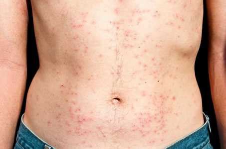 HIV rash-Pictures, Location, Causes, Symptoms & Treatment