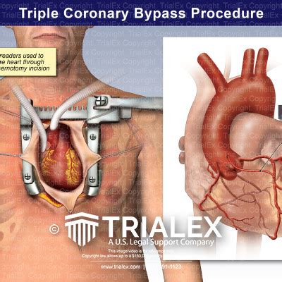 Triple Bypass Procedure - TrialExhibits Inc.