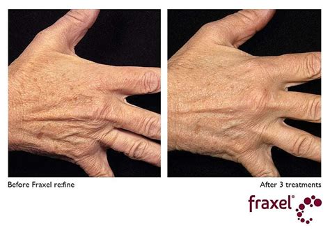 Fraxel laser for scars, spots and stretch marks