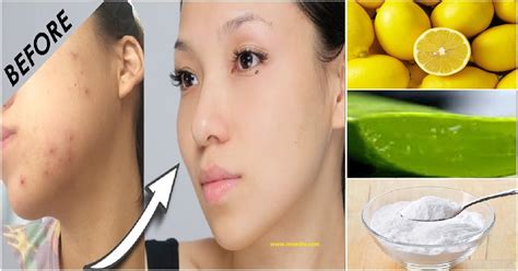 Homemade Tips For Remove Pimple Marks - Pimples, also called acne ...