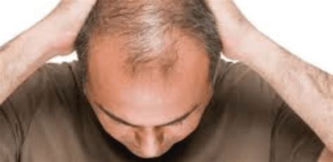 Hair Growth Surgery | ClinicExpert