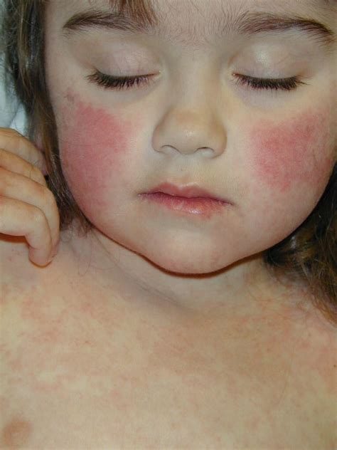 Skin Rashes in Children on Face in Adults on Hands on Arms that Itch In Kids on Dogs on Chest ...