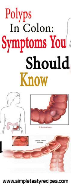 Here you have the most amazing natural remedies for colon polyps with propolis tincture, sitz ba ...