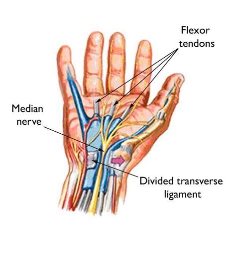 Do I Need Carpal Tunnel Surgery? - Orthopedic & Sports Medicine