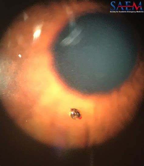 SAEM Clinical Image Series: Corneal Foreign Body