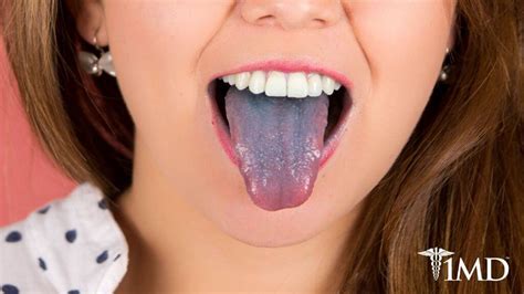 From Food to Medical Concerns: 8 Reasons Why Your Tongue Is Purple ...