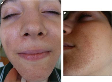 A) Circular reddish-brown pigmentation around the mouth and nose with... | Download Scientific ...