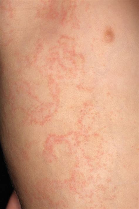 Erythematous Papular Rash