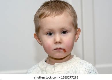 Acute Herpetic Stomatitis Children Infectious Viral Stock Photo 1585277293 | Shutterstock