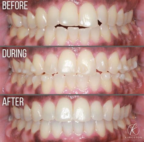 Crowded Teeth: Causes, Treatments & Costs