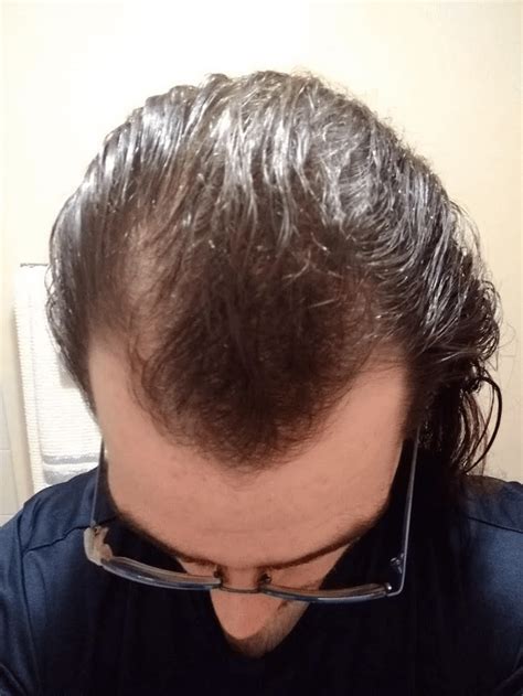 One year on Finasteride results. 1mg a day, everyday. : r/tressless