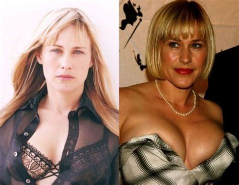 Patricia Arquette Before And After Plastic Surgery