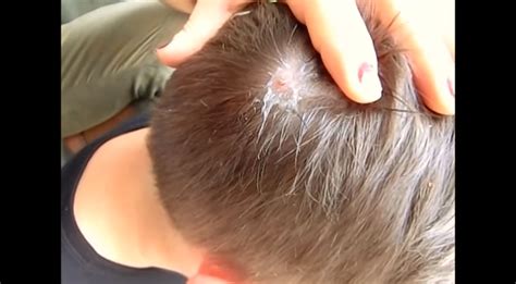 The Grossest BotFly Removal From This Boy’s Head Is Tough To Watch [VIDEO]