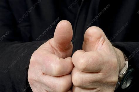 Amputated thumb - Stock Image - C015/6154 - Science Photo Library