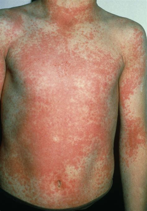 Managing scarlet fever | The BMJ