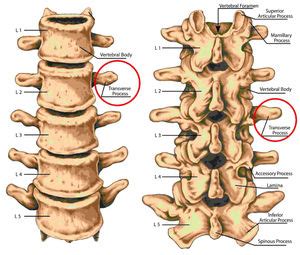 Transverse Process Fractures. A Broken Spine From Crashing