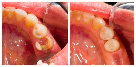 Incappucciamento diretto della polpa del dente in casi di pulpite