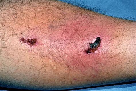 Cellulitis Following Leg Injury Photograph by Dr P. Marazzi/science Photo Library