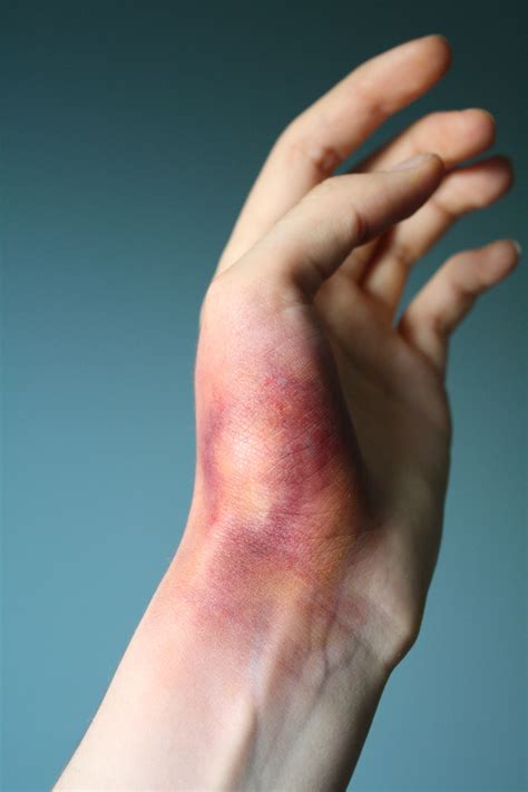 First stage of a bruise. Bruises occur when blood vessels break, due to ...