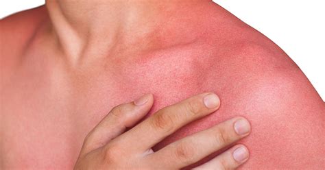 Heat rash, sun rash -- what's the difference? | OSF HealthCare