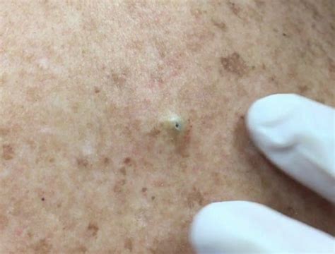 Watch: Dr Pimple Popper cyst removal after 10 years.