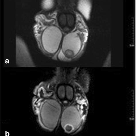 Scrotal MRI of patient with simple testicular epidermoid cyst, 1.5... | Download Scientific Diagram