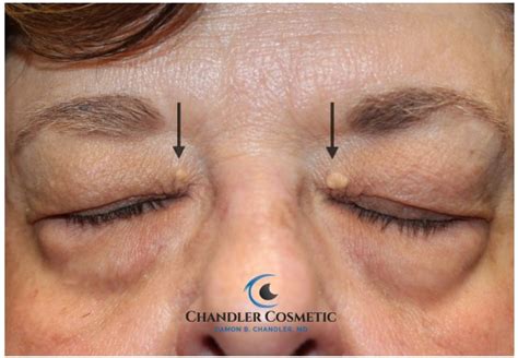 Xanthelasma Removal Surgery 60 Hours Post Op