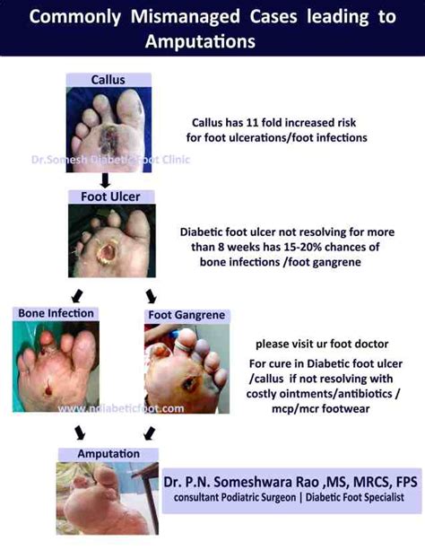 Diabetic Foot Ulcer Stages 2nd MTP region - Podiatry Doctor