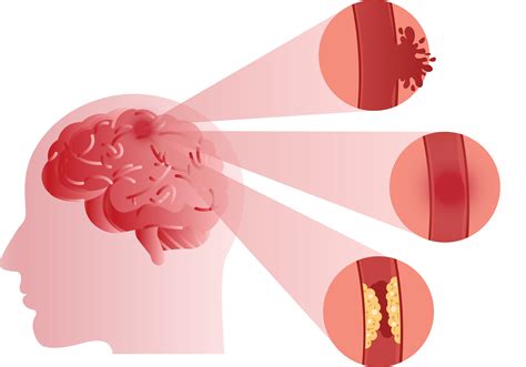 First Aid For Heart Stroke