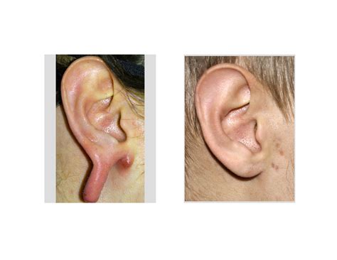 Case Study: Repair of the Torn Gauged Earlobe - Explore Plastic Surgery