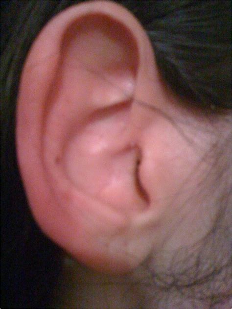 Red ear syndrome precipitated by a dietary trigger a case report journal of medical case reports ...