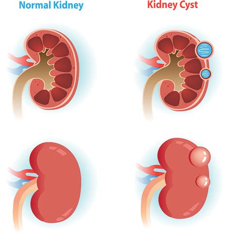 Kidney Cysts - Broward Urology Center