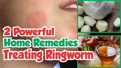 2 Powerful Home Remedies For Treating Ringworm - YouTube