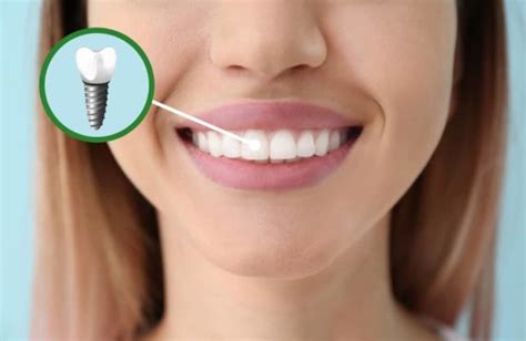 5 Facts About the Dental Implant Recovery Process | Houston