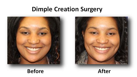 Dimple Creation Surgery Before And After