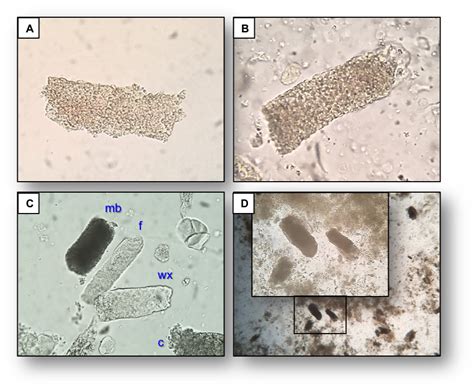 Urine Sediment of the Month: Granular & "Muddy Brown" Casts - Renal Fellow Network