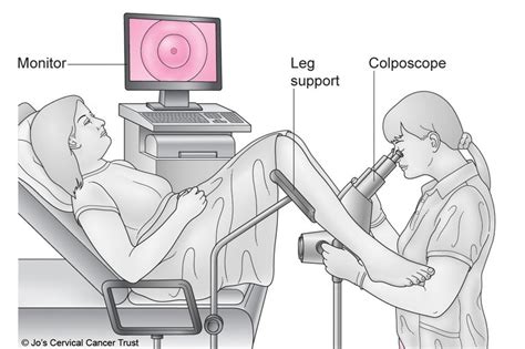 Colposcopy - What happens - NHS