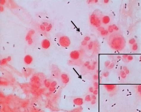 Sputum Sample: Collection, Transport, Staining, and Culture • Microbe ...