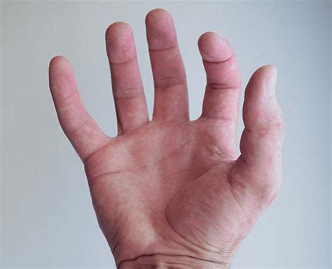 Claw hand: How to deal with the debilitating deformity