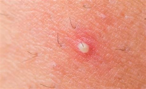 ingrown hair boil pictures - Miesha Short