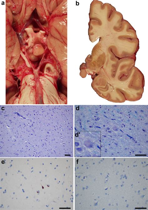 Macroscopic and microscopic photographs of the hypothalamic hamartoma ...